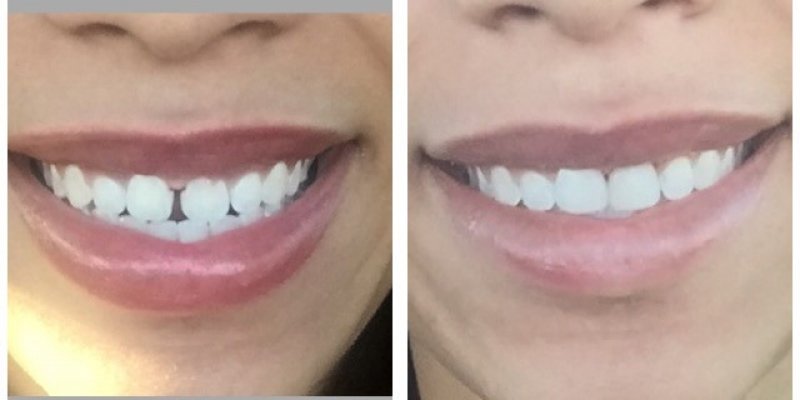 Smile Before & After 9